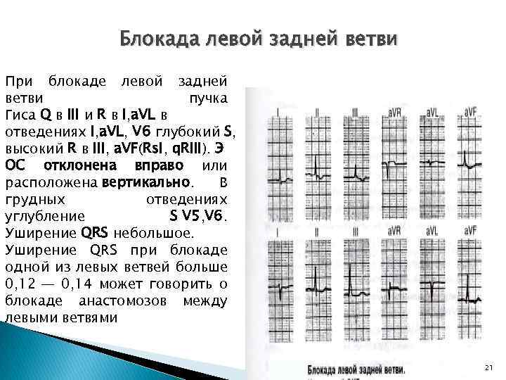 Блокада левой задней ветви При блокаде левой задней ветви пучка Гиса Q в III