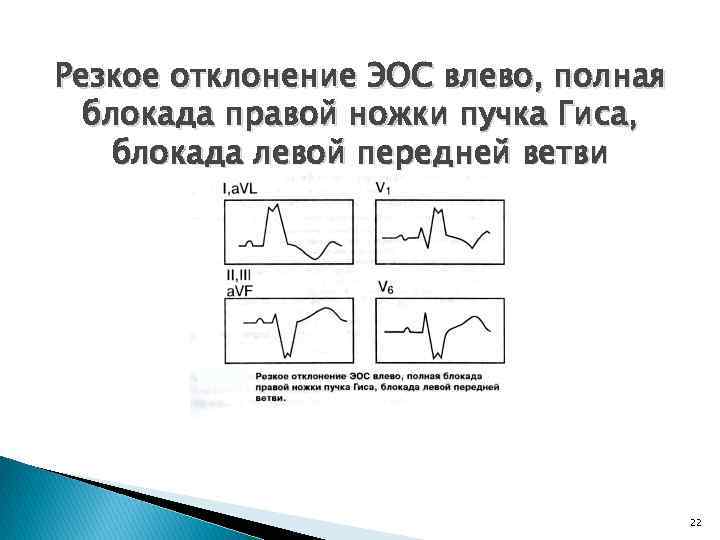 Отклонение эос влево