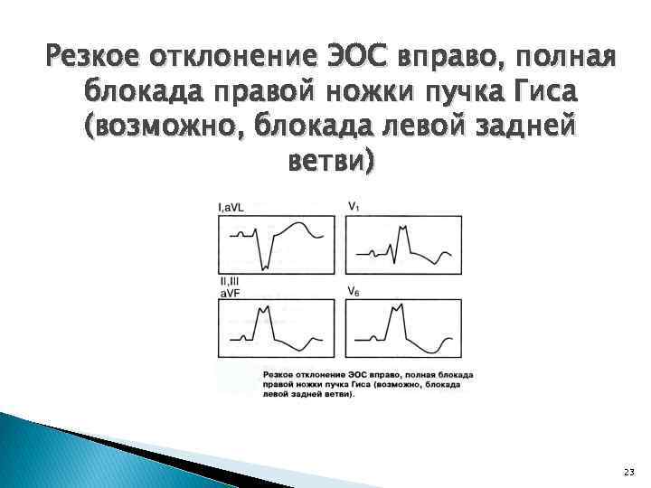 Отклонение электрической оси