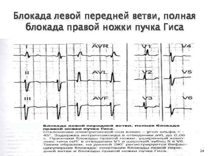 Правая ножка пучка. Блокада ПНПГ И передней ветви ЛНПГ на ЭКГ. Полная блокада левой ветви пучка Гиса на ЭКГ. Блокада передней ветви правой ножки пучка Гиса. Блокада правой ножки пучка Гиса и гипертрофия правого желудочка.