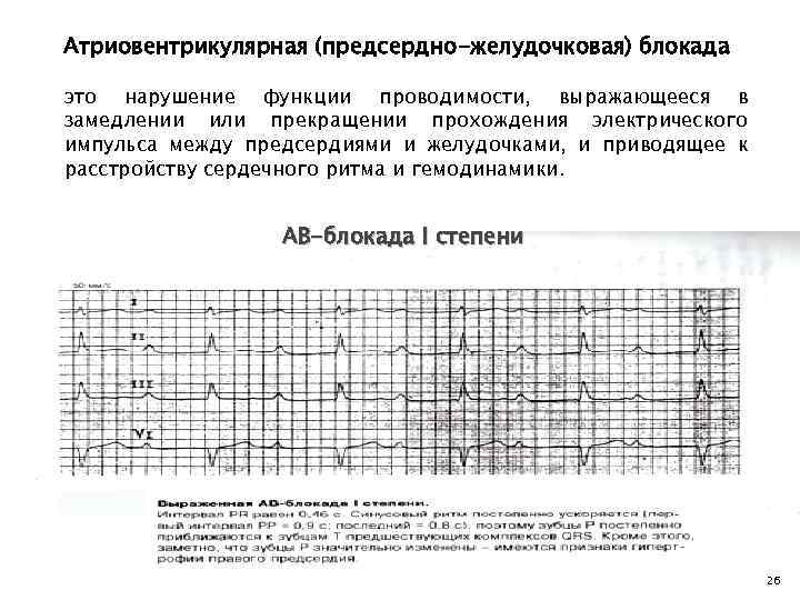 Атриовентрикулярная (предсердно-желудочковая) блокада это нарушение функции проводимости, выражающееся в замедлении или прекращении прохождения электрического