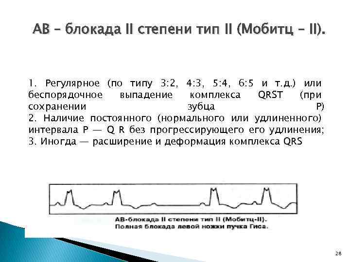 АВ – блокада II степени тип II (Мобитц – II). 1. Регулярное (по типу