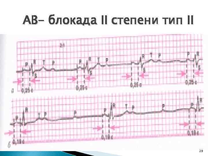 АВ- блокада II степени тип II 29 