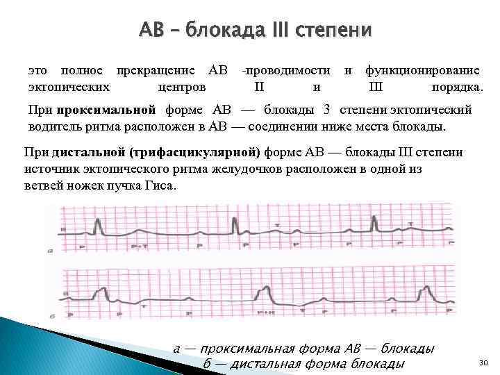 Блокада инструкция. АВ блокада 3 степени ритм. АВ блокада 3 степени дистальный Тип. Какой ритм при АВ блокаде 3 степени. АВ блокада 3 степени проксимальный и дистальный.