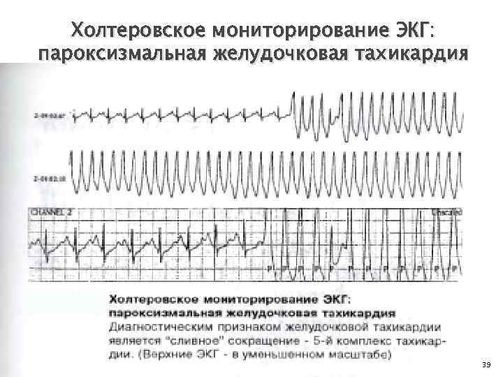 Холтеровское мониторирование ЭКГ: пароксизмальная желудочковая тахикардия 39 