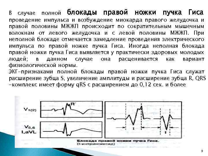 Полная блокада левой ножки карта вызова