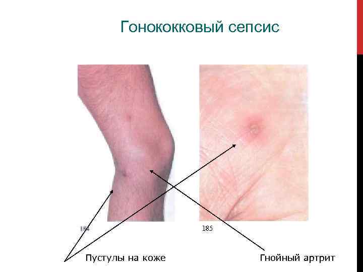 Гонококковый сепсис Пустулы на коже Гнойный артрит 