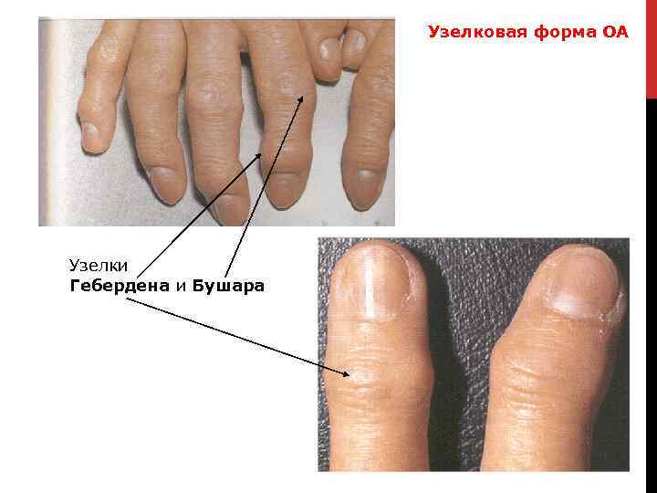 Узелковая форма ОА Узелки Гебердена и Бушара 