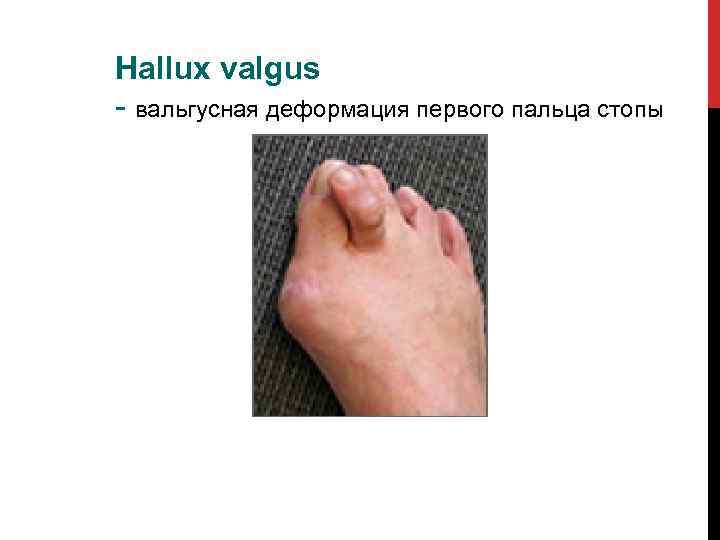 Hallux valgus - вальгусная деформация первого пальца стопы 