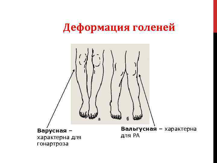 Варусная деформация. Варусная деформация стопы рентген. Варусное искривление оси конечности. Варусная деформация голени рентген. Варусная деформация голени.