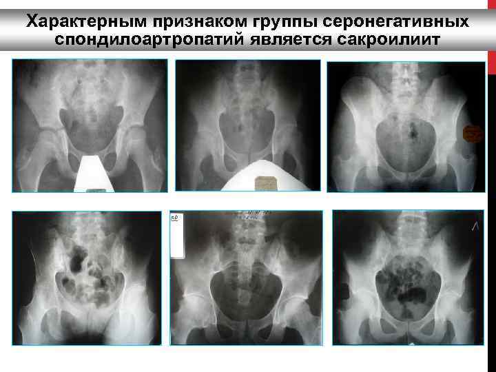 Характерным признаком группы серонегативных спондилоартропатий является сакроилиит 