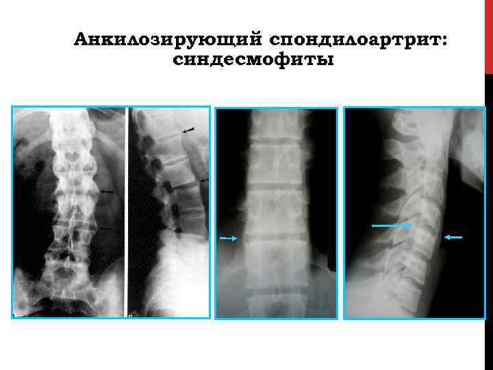 Анкилозирующий спондилоартрит: синдесмофиты 