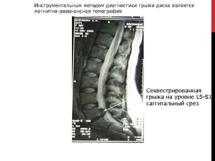 Инструментальным методом диагностики грыжи диска является магнитно-резонансная томография Секвестрированная грыжа на уровне L 5