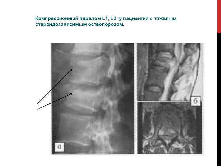 Компрессионный перелом L 1, L 2 у пациентки с тяжелым стероидозависимым остеопорозом. 