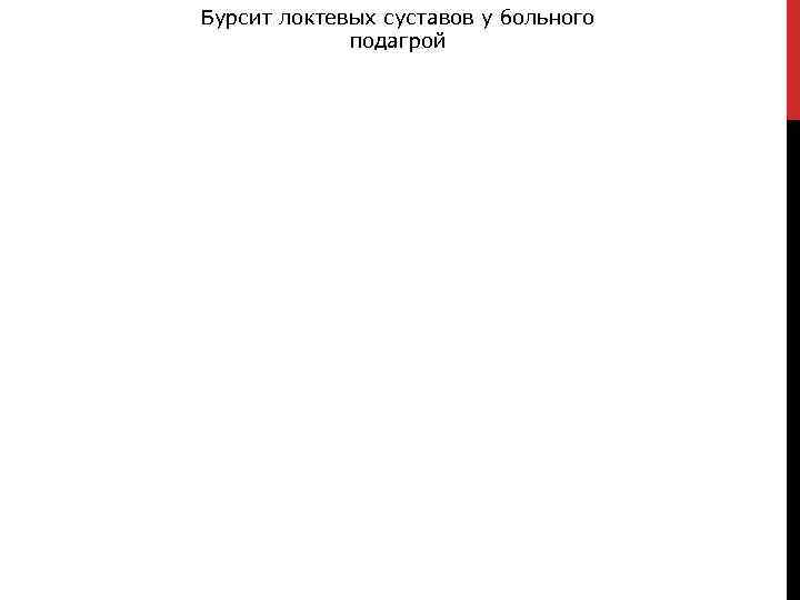 Бурсит локтевых суставов у больного подагрой 