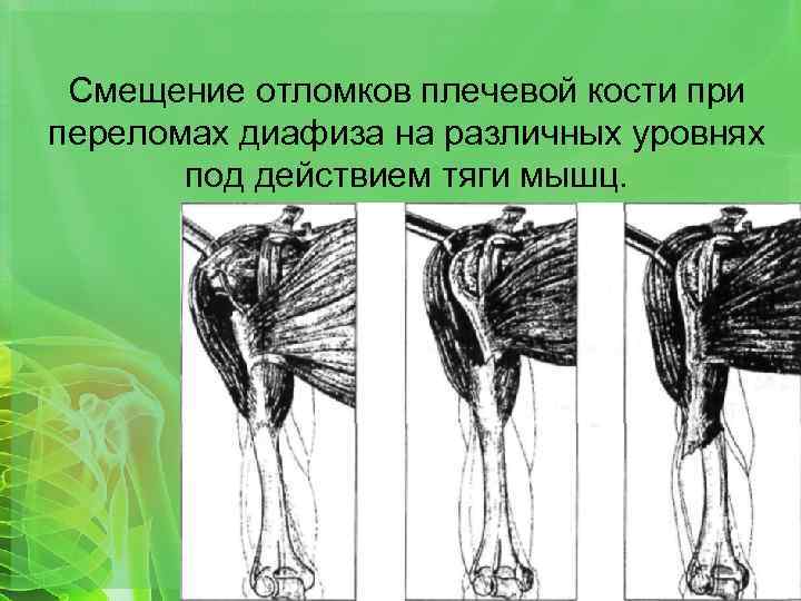 Смещение отломков плечевой кости при переломах диафиза на различных уровнях под действием тяги мышц.