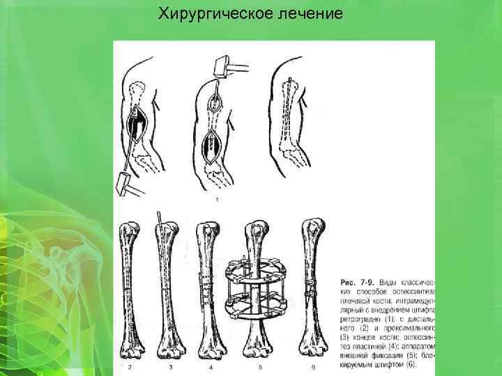 Хирургическое лечение 