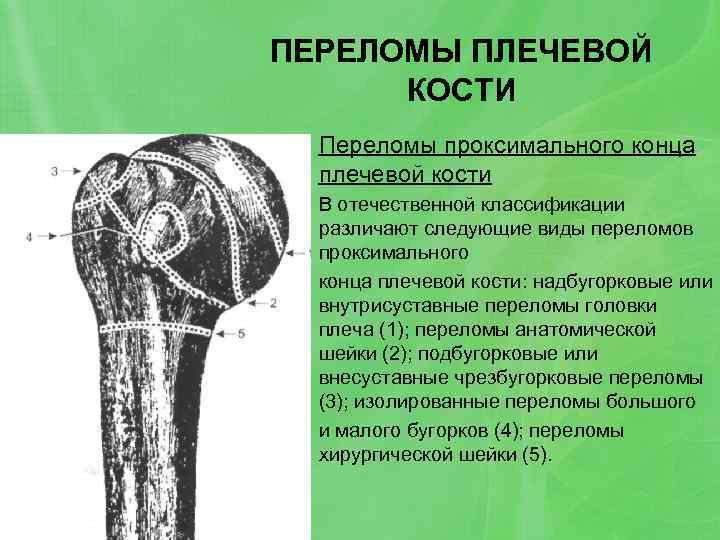 ПЕРЕЛОМЫ ПЛЕЧЕВОЙ КОСТИ Переломы проксимального конца плечевой кости В отечественной классификации различают следующие виды