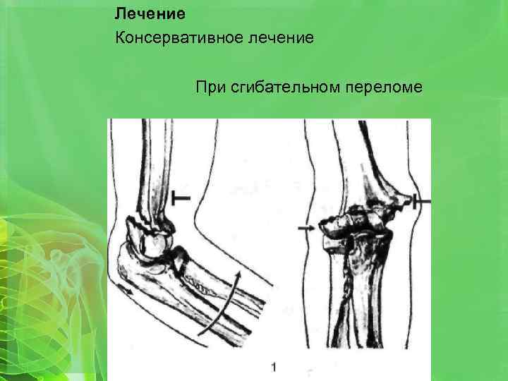 Лечение Консервативное лечение При сгибательном переломе 