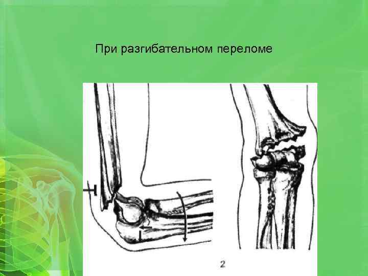 При разгибательном переломе 