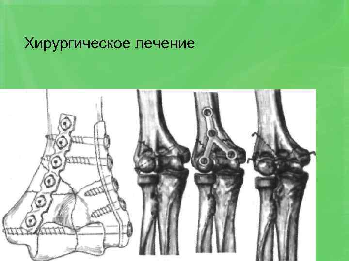Хирургическое лечение 