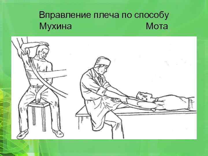 Вправление плеча по способу Мухина Мота 
