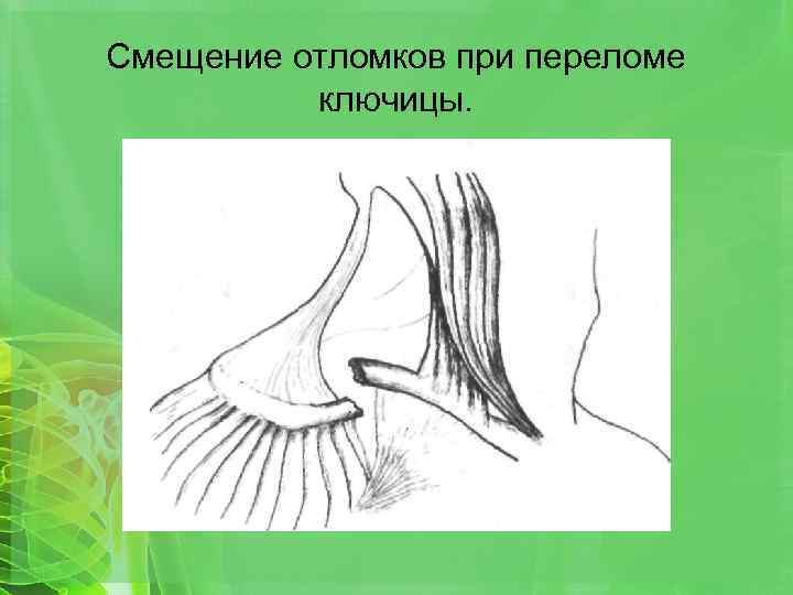 Смещение отломков при переломе ключицы. 