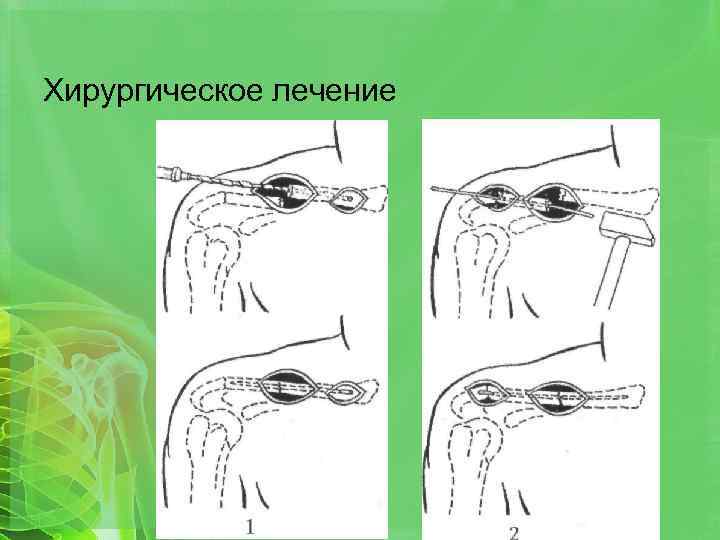 Хирургическое лечение 