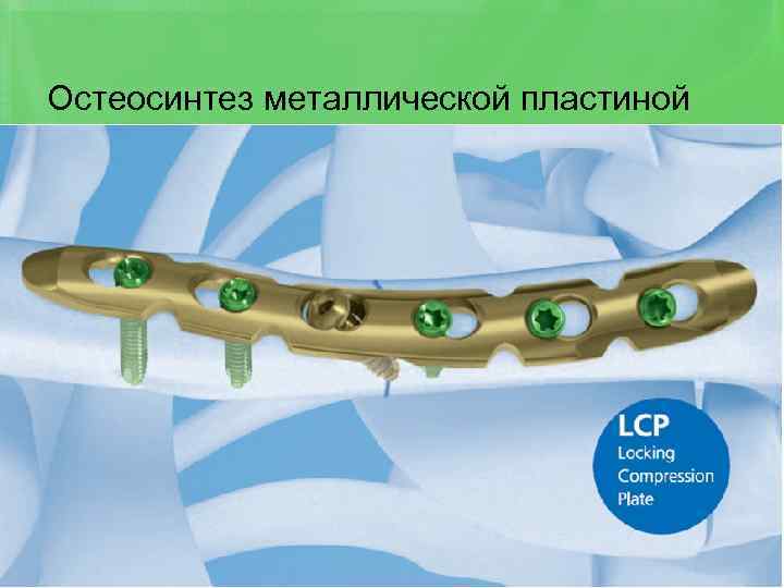 Остеосинтез металлической пластиной 