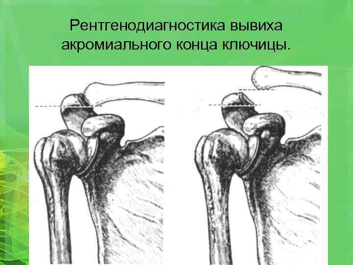 Рентгенодиагностика вывиха акромиального конца ключицы. 