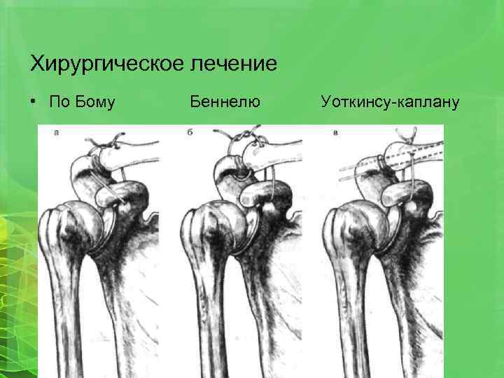 Хирургическое лечение • По Бому Беннелю Уоткинсу-каплану 