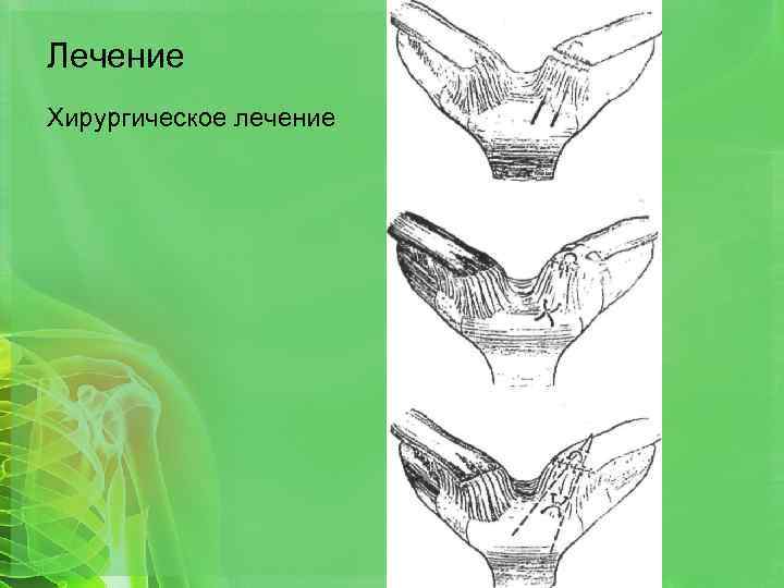 Лечение Хирургическое лечение 