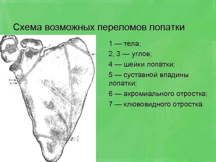 Схема возможных переломов лопатки 1 — тела; 2, 3 — углов; 4 — шейки