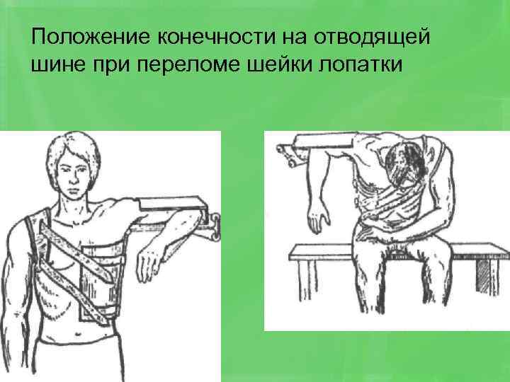 Положение конечности на отводящей шине при переломе шейки лопатки 