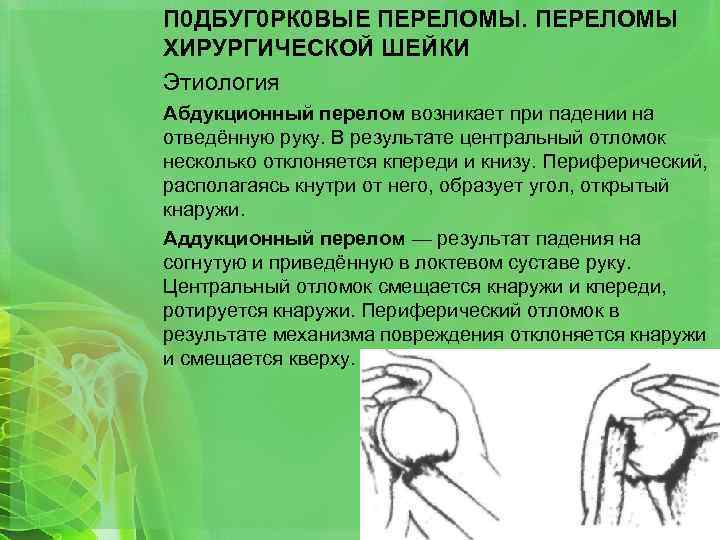 П 0 ДБУГ 0 РК 0 ВЫЕ ПЕРЕЛОМЫ ХИРУРГИЧЕСКОЙ ШЕЙКИ Этиология Абдукционный перелом возникает