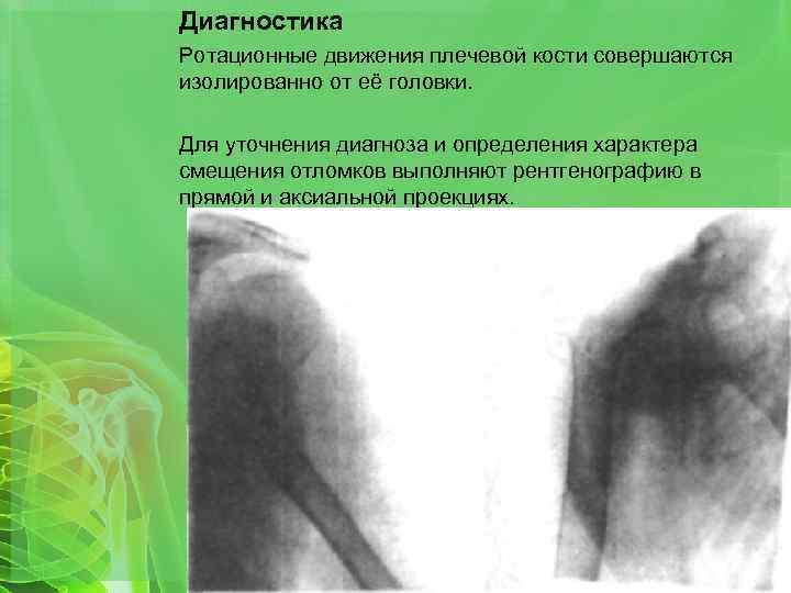 Диагностика Ротационные движения плечевой кости совершаются изолированно от её головки. Для уточнения диагноза и
