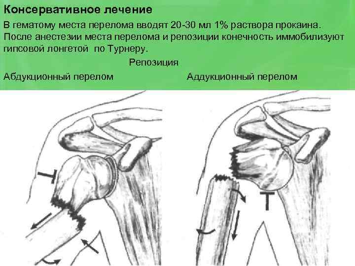 Консервативное лечение В гематому места перелома вводят 20 -30 мл 1% раствора прокаина. После