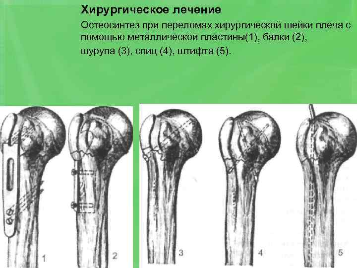 Хирургическое лечение Остеосинтез при переломах хирургической шейки плеча с помощью металлической пластины(1), балки (2),