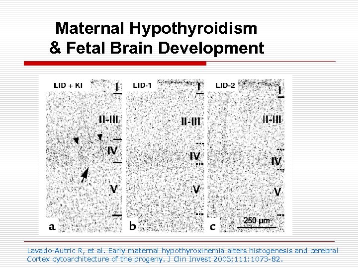 Maternal Hypothyroidism & Fetal Brain Development Lavado-Autric R, et al. Early maternal hypothyroxinemia alters