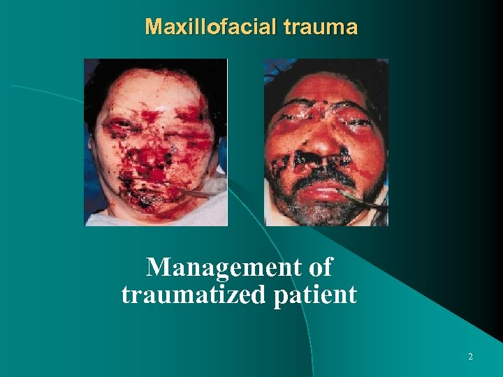 Maxillofacial trauma Management of traumatized patient 2 