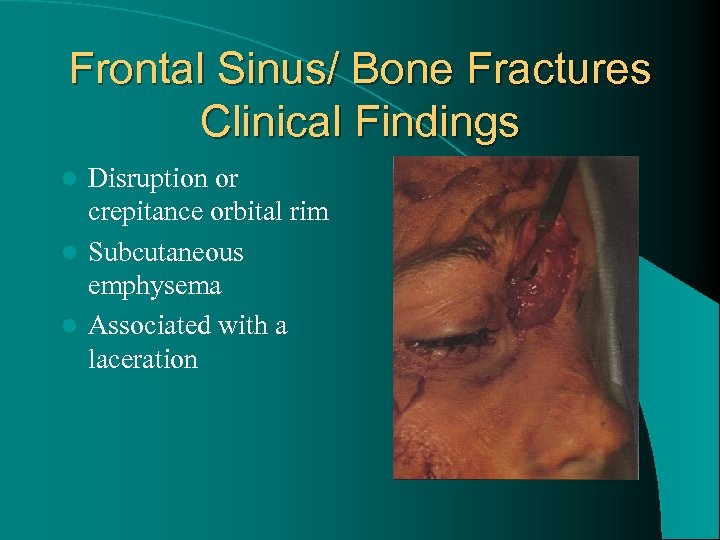 Frontal Sinus/ Bone Fractures Clinical Findings Disruption or crepitance orbital rim l Subcutaneous emphysema
