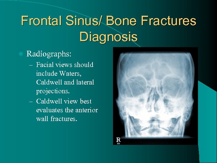 Frontal Sinus/ Bone Fractures Diagnosis l Radiographs: – Facial views should include Waters, Caldwell