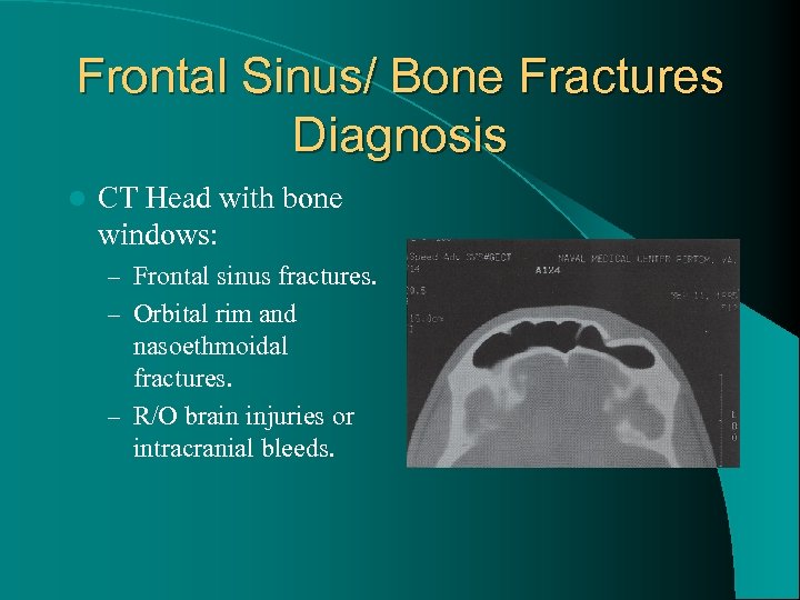 Frontal Sinus/ Bone Fractures Diagnosis l CT Head with bone windows: – Frontal sinus
