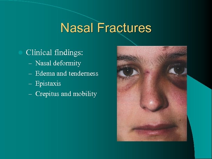 Nasal Fractures l Clinical findings: – Nasal deformity – Edema and tenderness – Epistaxis