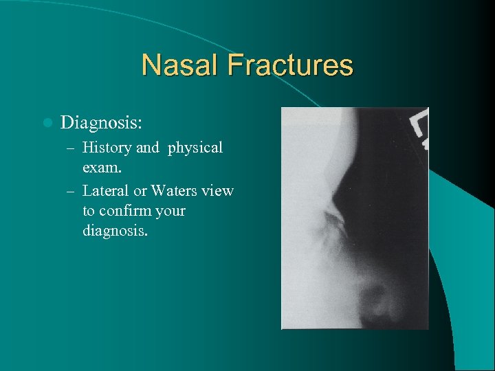 Nasal Fractures l Diagnosis: – History and physical exam. – Lateral or Waters view