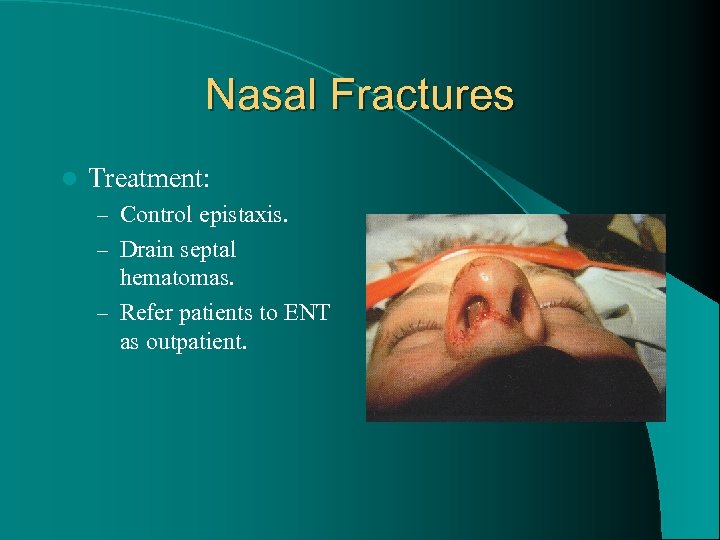 Nasal Fractures l Treatment: – Control epistaxis. – Drain septal hematomas. – Refer patients