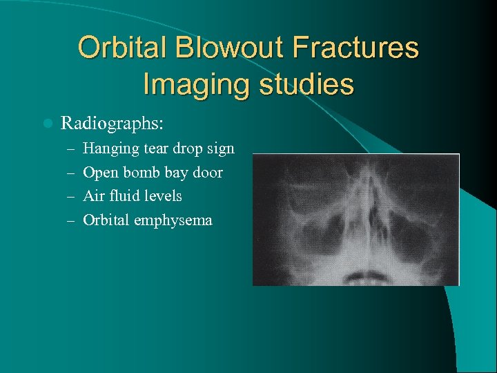 Orbital Blowout Fractures Imaging studies l Radiographs: – Hanging tear drop sign – Open