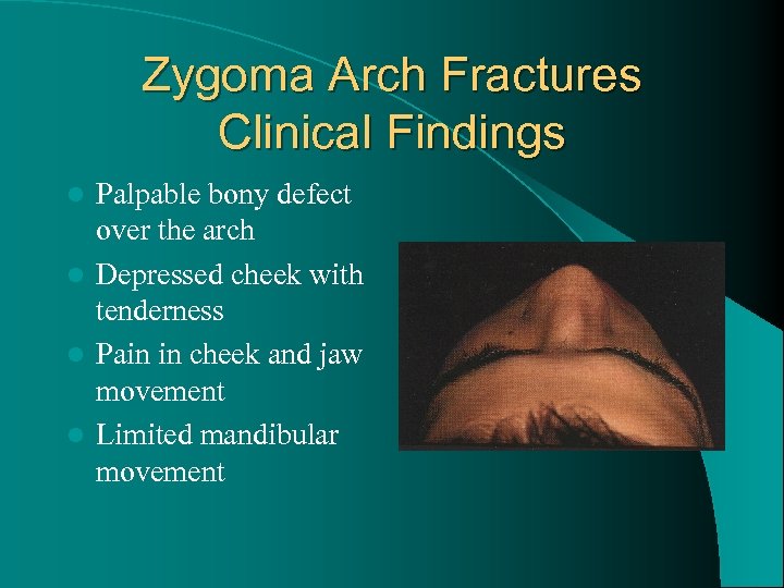 Zygoma Arch Fractures Clinical Findings Palpable bony defect over the arch l Depressed cheek
