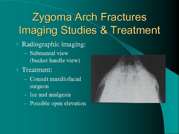 Zygoma Arch Fractures Imaging Studies & Treatment l Radiographic imaging: – Submental view (bucket