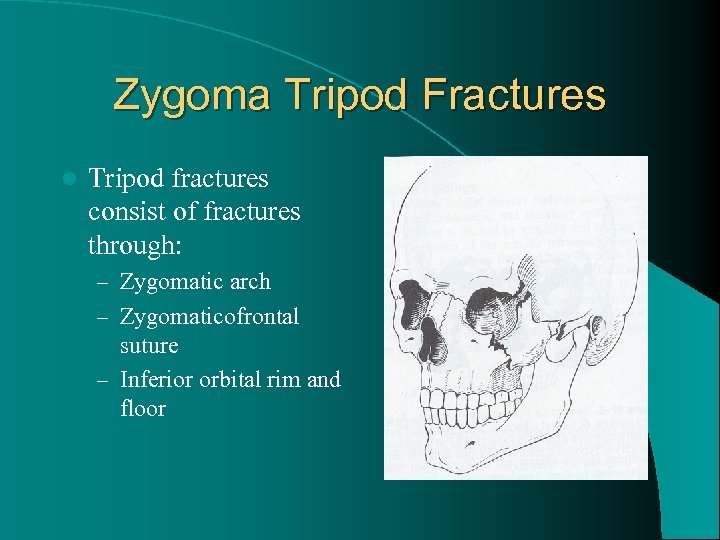 Zygoma Tripod Fractures l Tripod fractures consist of fractures through: – Zygomatic arch –